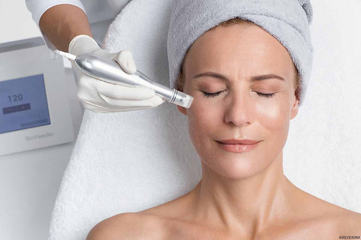 micro needling